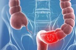Рак кишечника - ознаки, симптоми на ранніх стадіях, лікування та прогноз
